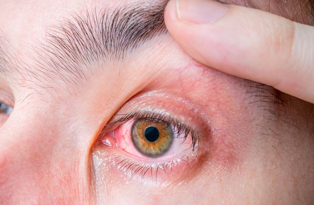 Los oftalmólogos adviertes que la conjuntivitis podría ser una señal de cuadro positivo de la enfermedad.