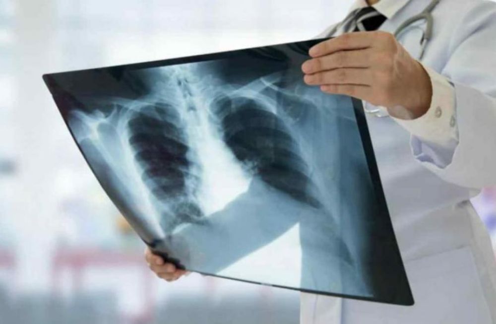 La tuberculosis provoca más de 11 mil nuevos casos en Argentina por año
