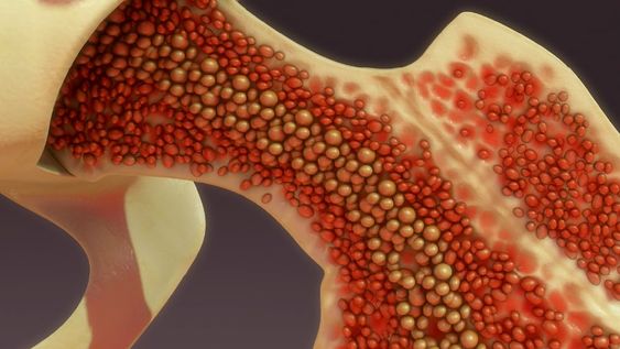 ¿Por qué es tan importante ser donante de médula ósea?