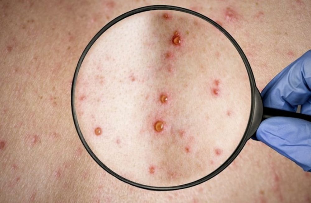 La viruela símica (mpox) es una enfermedad vírica causada por el virus de la mpox, que pertenece al género de los Orthopoxvirus, tal cual describe la Organización Mundial de la Salud (OMS).