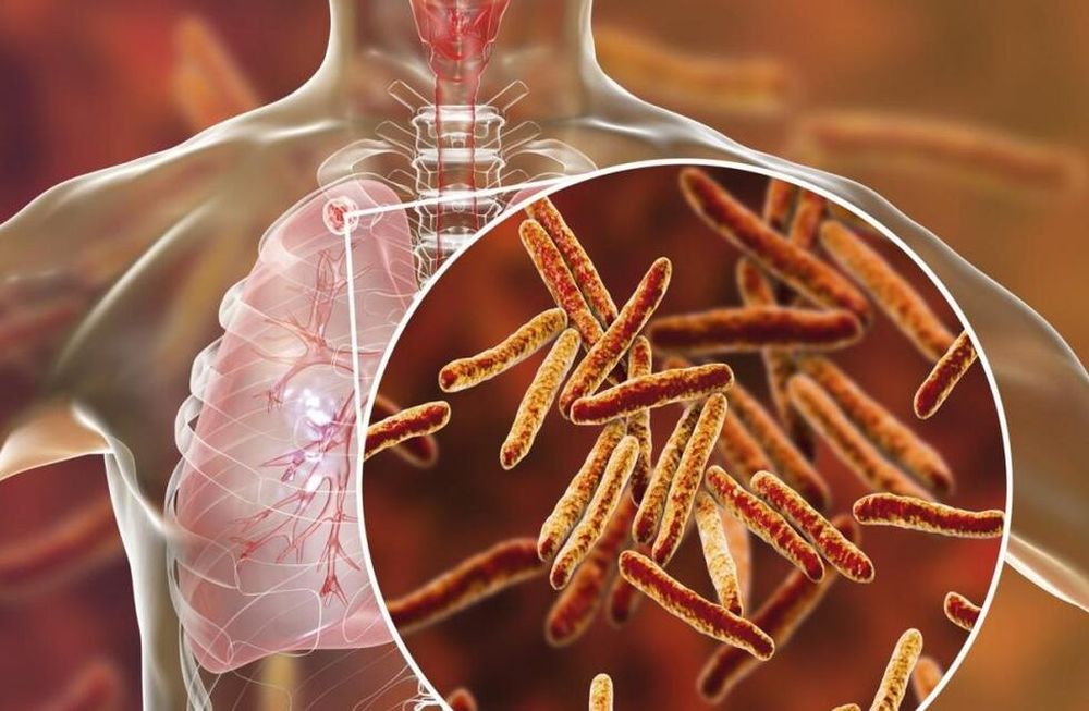 ¿Qué es la tuberculosis y cómo se trata?