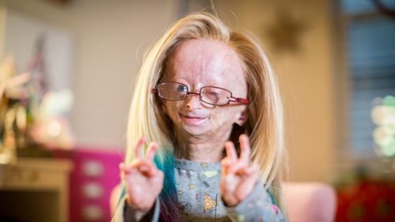 Adalia Rose, la joven con envejecimiento prematura que falleció hace algunas horas.