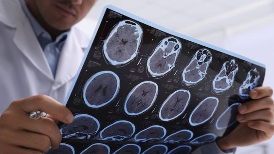 &nbsp;Investigadores de un centro de Estados Unidos detectaron que una proteína asociada al Parkinson determina una progresión más rápida del Alzheimer en mujeres.