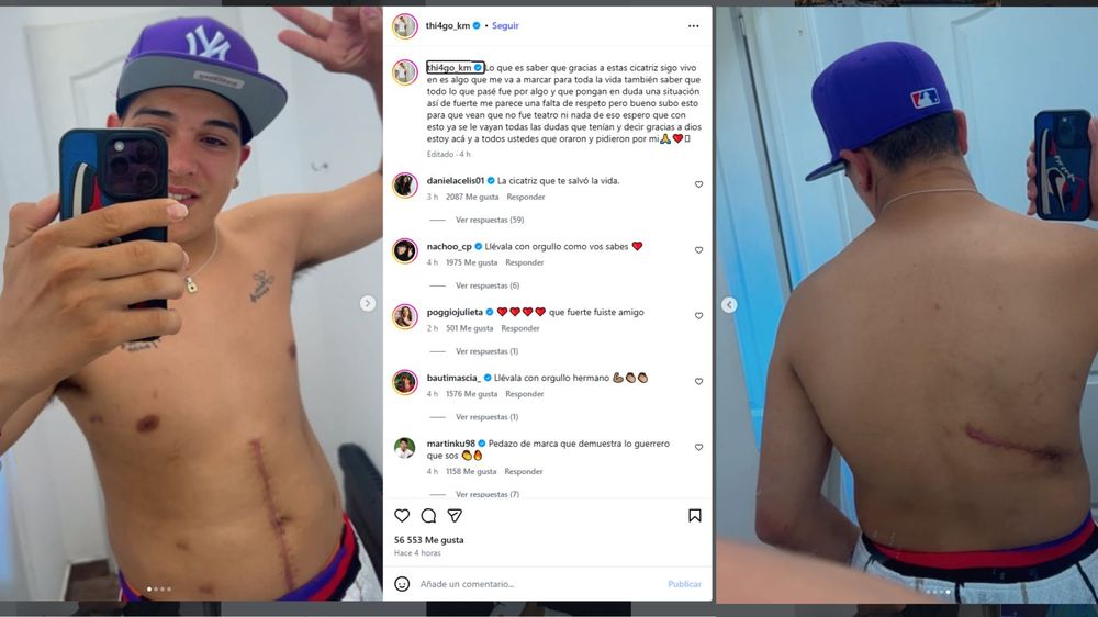 Thiago Medina mostró sus cicatrices en sus redes