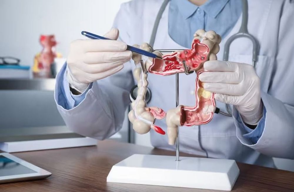 Cáncer de colon: el 90% de los casos se puede prevenir y curar