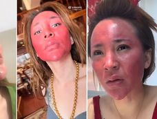 Una mujer china de 37 años, mostró en redes su piel inflamada y roja tras décadas sin limpiarse el rostro con productos adecuados.&nbsp;