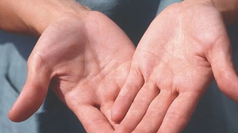 Este cambio suele afectar a ambas manos, produce enrojecimiento de la piel alrededor de la uña