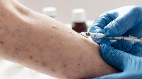 Sarampión: no había mendocinos en los micros donde se reportaron casos, pero llaman a estar atentos a síntomas