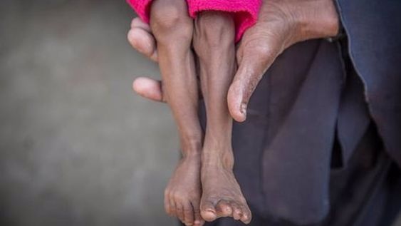 21/11/2018 Un niño con desnutrición.La organización no gubernamental Save the Children ha denunciado este miércoles que cerca de 85.000 niños menores de cinco años podrían haber muerto por inanición desde abril de 2015 en Yemen como consecuencia de la guerra que está viviendo el país.POLITICA ORIENTE PRÓXIMO ASIA INTERNACIONAL YEMENSAVE THE CHILDREN