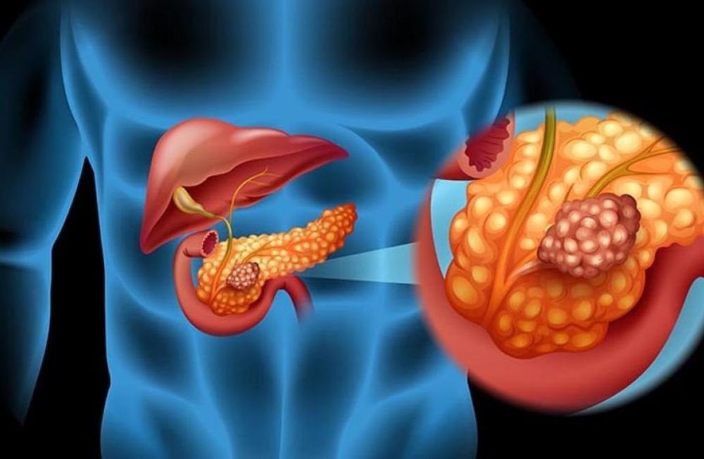 ¿Cómo podemos prevenir el cáncer de páncreas?
