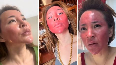 Una mujer china de 37 años, mostró en redes su piel inflamada y roja tras décadas sin limpiarse el rostro con productos adecuados.&nbsp;