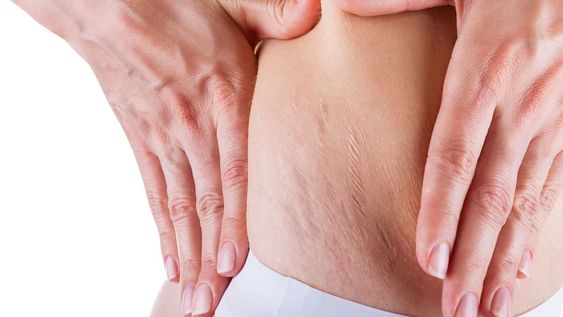 Síndrome de Cushing: signos y síntomas del aumento de cortisol en el cuerpo