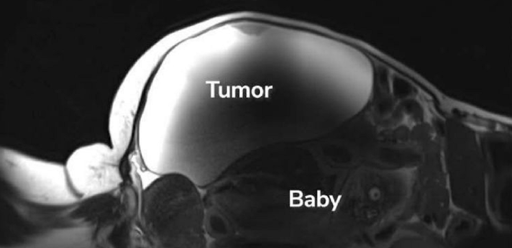 El embarazo ectópico abdominal es extremadamente raro y conlleva altos riesgos para la madre y el bebé.