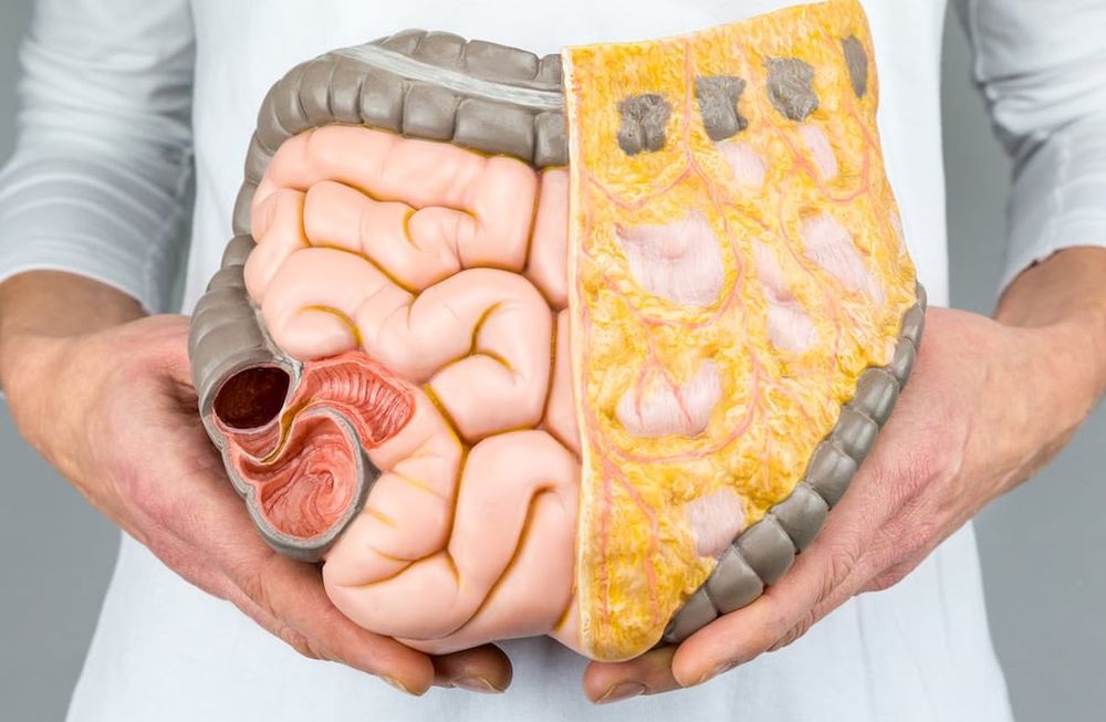 El colorrectal es la tercera causa de cáncer en la Argentina