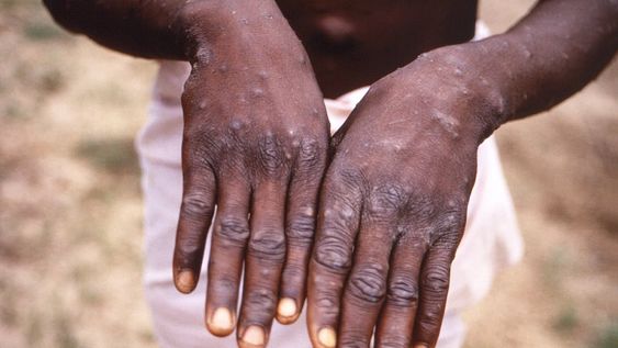 La viruela símica, o mpox, es una patología endémica de los países de África central y occidental, pero desde el 14 de agosto, se ha transformado en emergencia de salud pública de importancia internacional (CDC vía AP, Archivo)