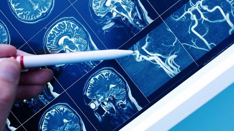 Los Andes | Aneurisma cerebral.jpg