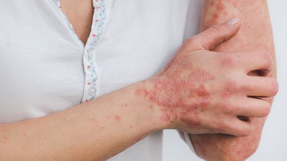 Psoriasis: la importancia de diagnosticar y tratar a tiempo
