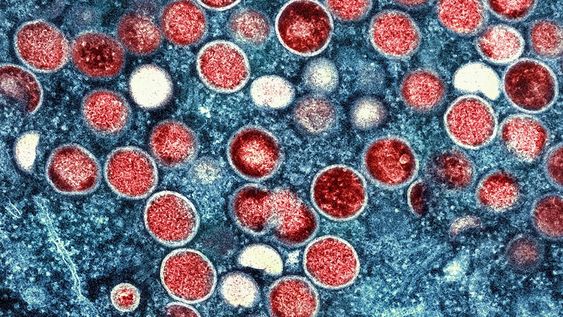 La Organización Mundial de la Salud declaró recientemente que el brote de viruela del simio en expansión es una emergencia mundial. (AP)