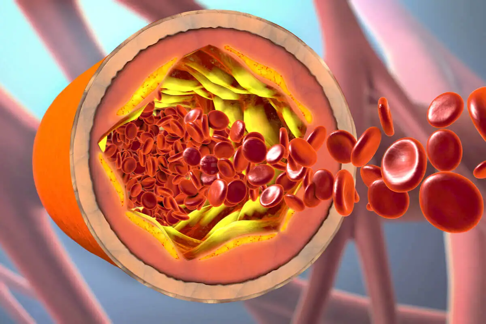 Cuáles son los 3 alimentos que desinflaman arterias y bajan el colesterol.