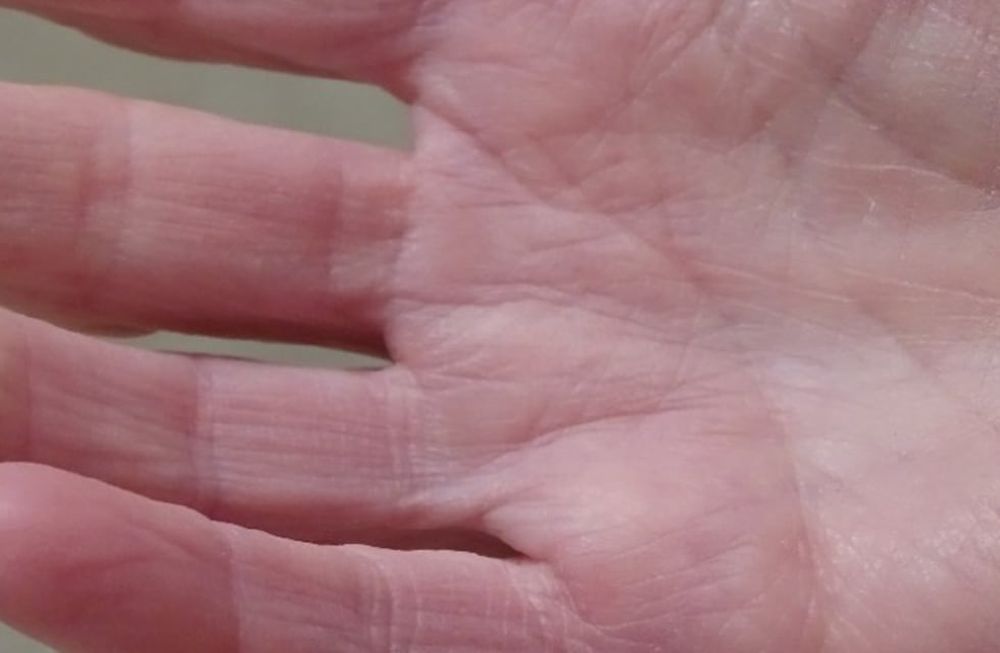 ¿Qué es la esclerodermia?