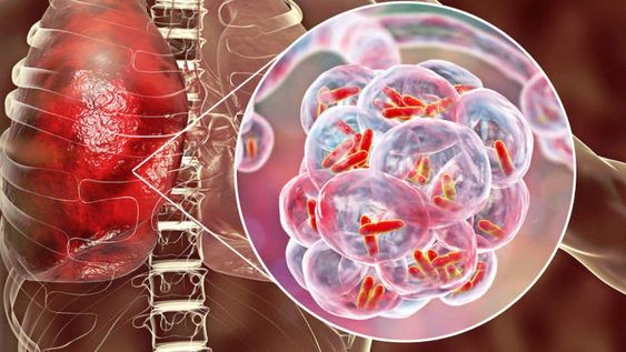 Es urgente reactivar los esfuerzos mundiales para acabar con la tuberculosis