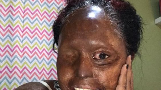 Esther ha sido sometida a 27 cirugías, incluyendo la extracción de su ojo izquierdo para que no perdiera su visión totalmente