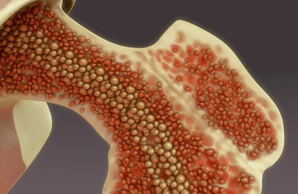 La campaña #MiDespués busca visibilizar el Mieloma