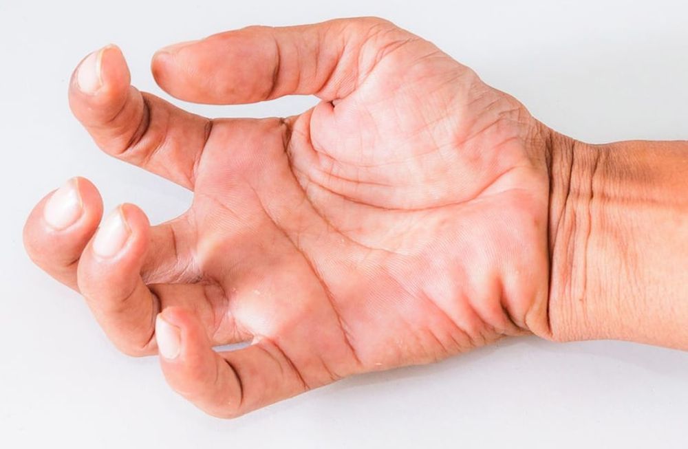 Luego de haber sufrido un accidente cerebrovascular (ACV), el 27% de los pacientes desarrolla espasticidad.