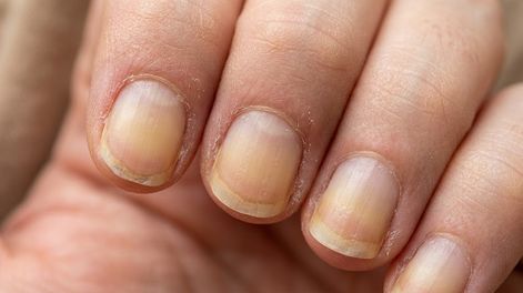 unas amarillas: por que aparecen, cuales son las senales a las que debes prestar atencion y cuando conviene consultar a un dermatologo