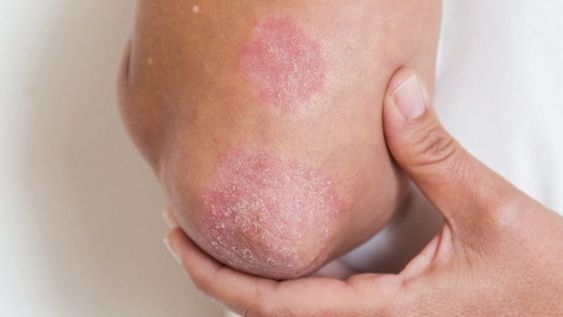 29 de octubre, Día Mundial de la Psoriasis