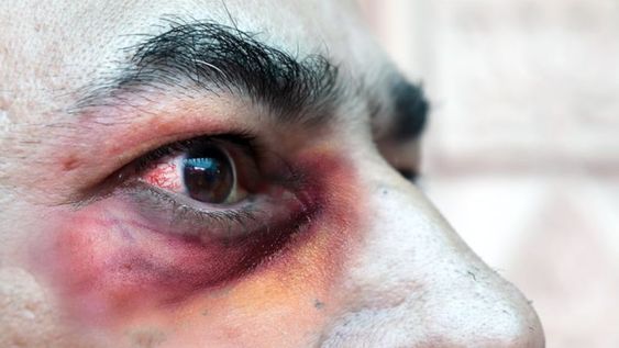 Nuestro país reportó la primera muerte producto de la murcomicosis, la infección conocida en el mundo como “hongo negro”. Foto: Gentileza