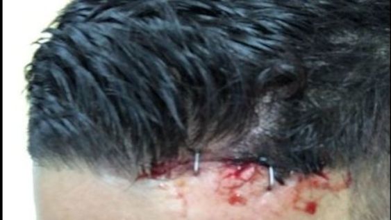 Marcos Rojo se rompió la cabeza y le cerraron la herida con una engrapadora