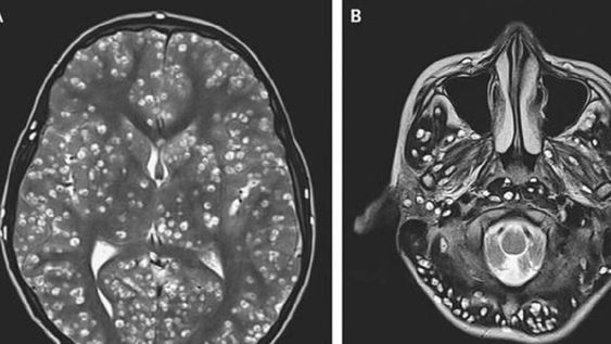 Le dolía la cabeza, fue al hospital y le descubrieron una plaga de larvas en el cerebro