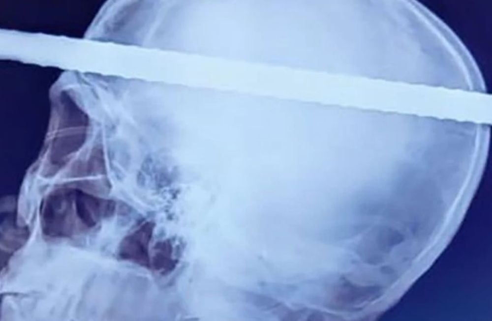 Un hombre sobrevivió milagrosamente luego de que una barra de hierro le cayera desde un piso 20 y le atravesara la cabeza. Foto: Gentileza