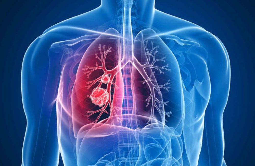 Terapias dirigidas y a medida: la medicina de precisión mejora el pronóstico de pacientes con cáncer de pulmón