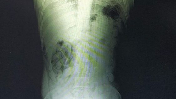 Una radiografía muestra la droga en el cuerpo de uno de los detenidos. Gentileza Gendarmería Nacional.&nbsp;